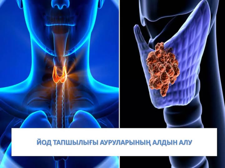 Профилактика йододефицитных заболеваний