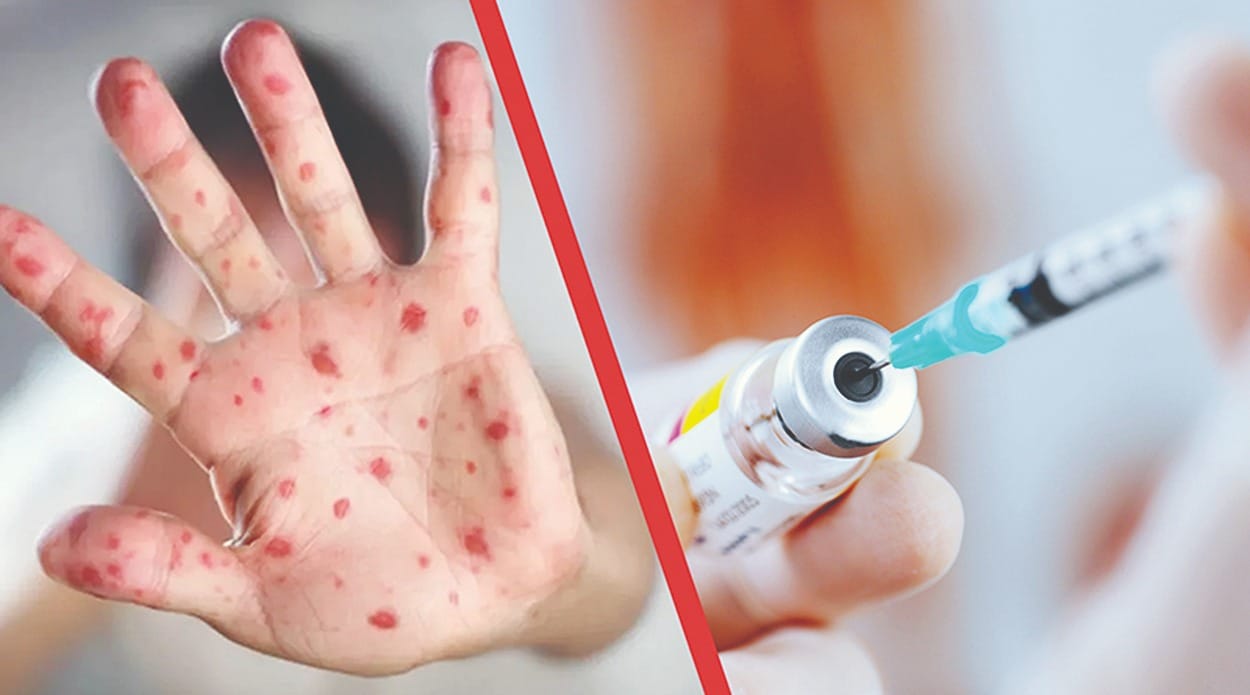 Вакцинация — ключевая мера профилактики и защиты населения против кори