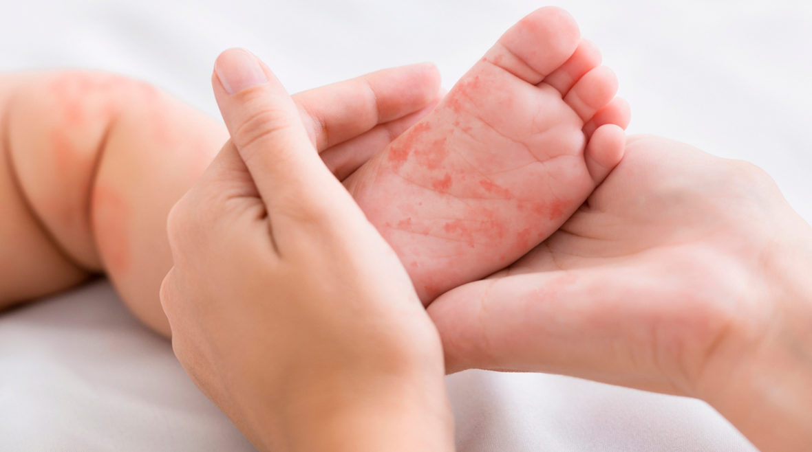 Профилактика кори