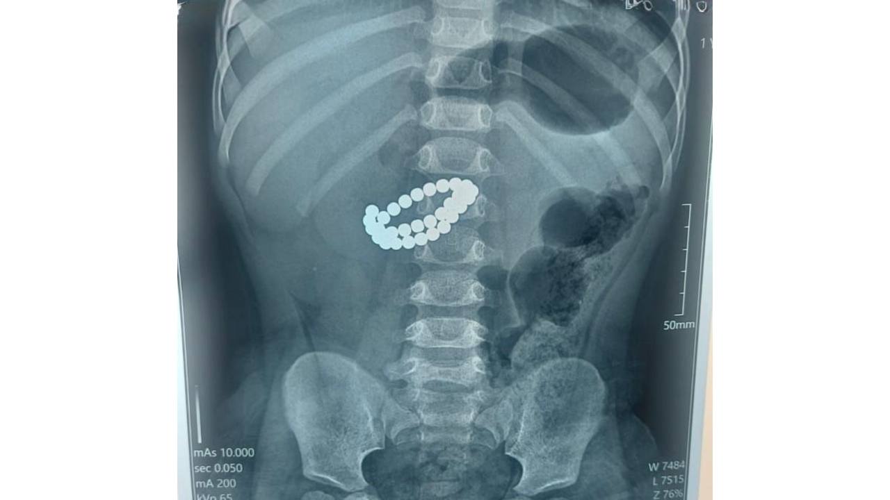 Малыш проглотил 31 магнит в Алматы