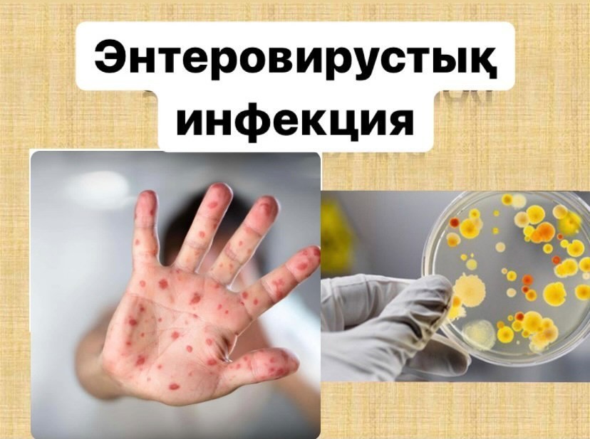 Энтеровирусы и Коксаки: Как защититься от летних инфекций