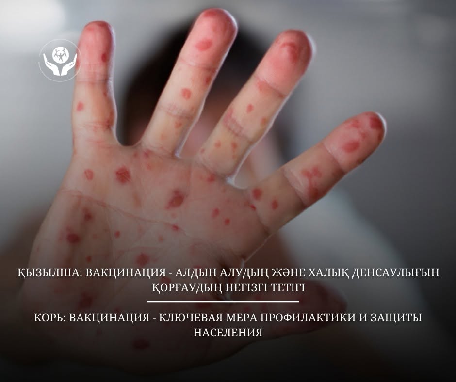 Корь: вакцинация — ключевая мера профилактики и защиты населения
