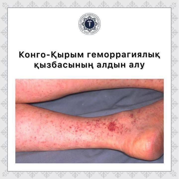 Конго-Крымская геморрагическая лихорадка Внимание!